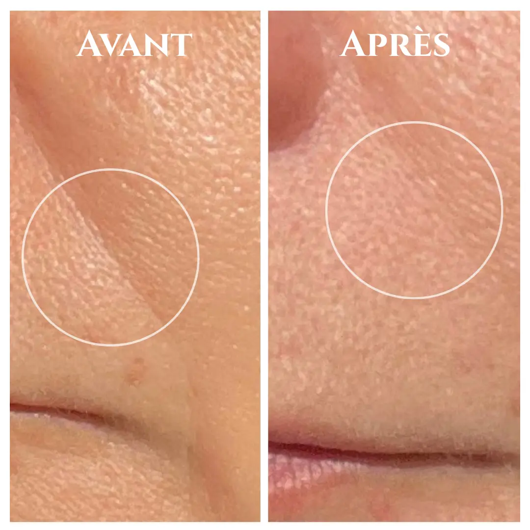 Avant / Après Radiofréquence & Lashlift : soin anti-âge
