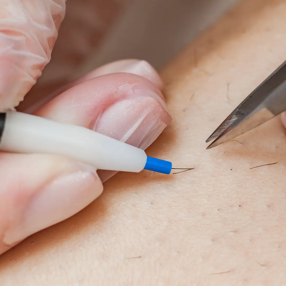 Crystelite : épilation définitive à Genève