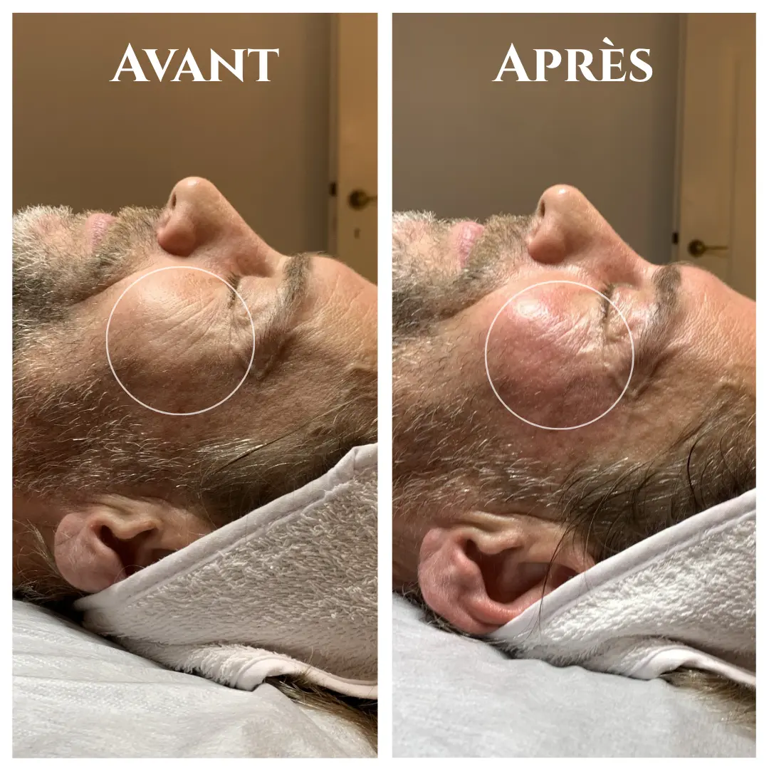 Avant / Après Tesla Med : soin du visage pour homme 